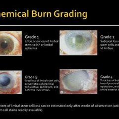 Best Chemical Burns To Eyes Treatment Reviews