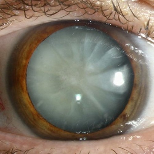 Kate Shemirani & James Harvey: Students Against Tyranny & Cataract Treatments
