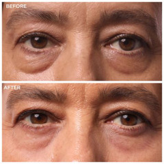 Best Under Eye Bags Treatment Reviews