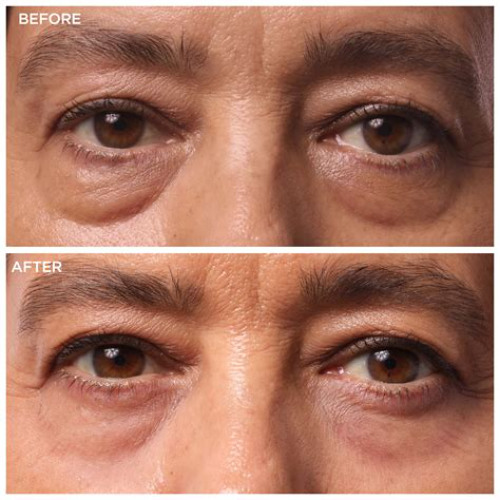 Best Under Eye Bags Treatment Reviews