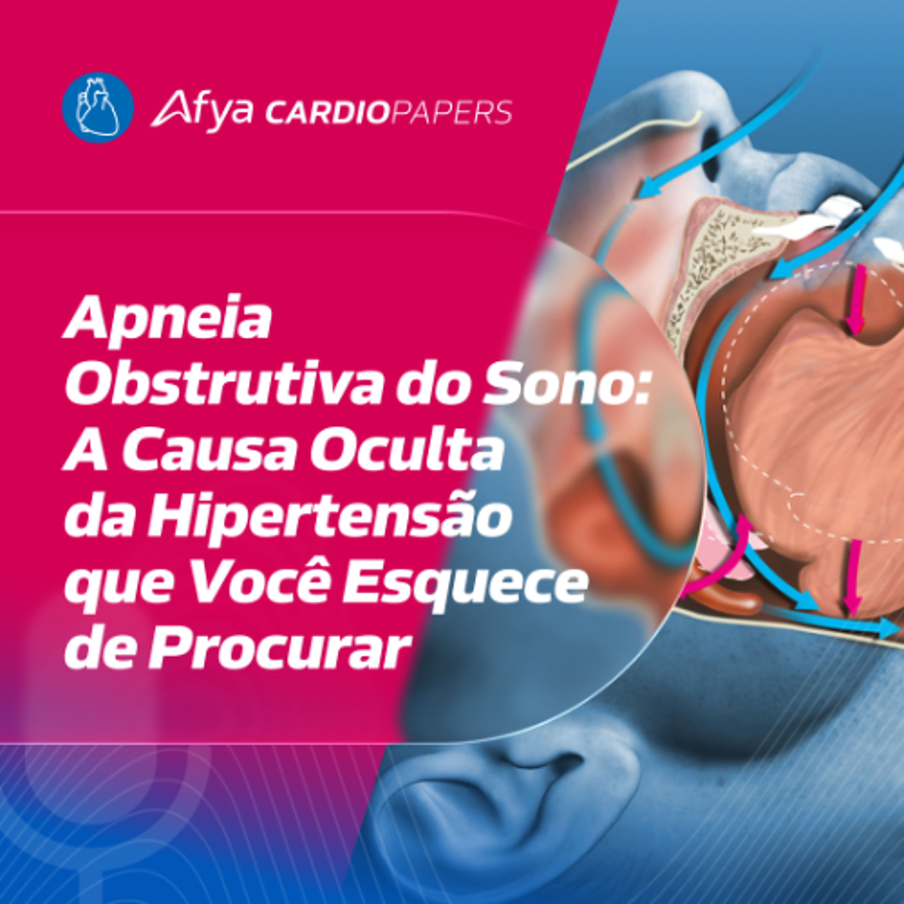 Hiperaldosteronismo: Quem Deve Ser Investigado?