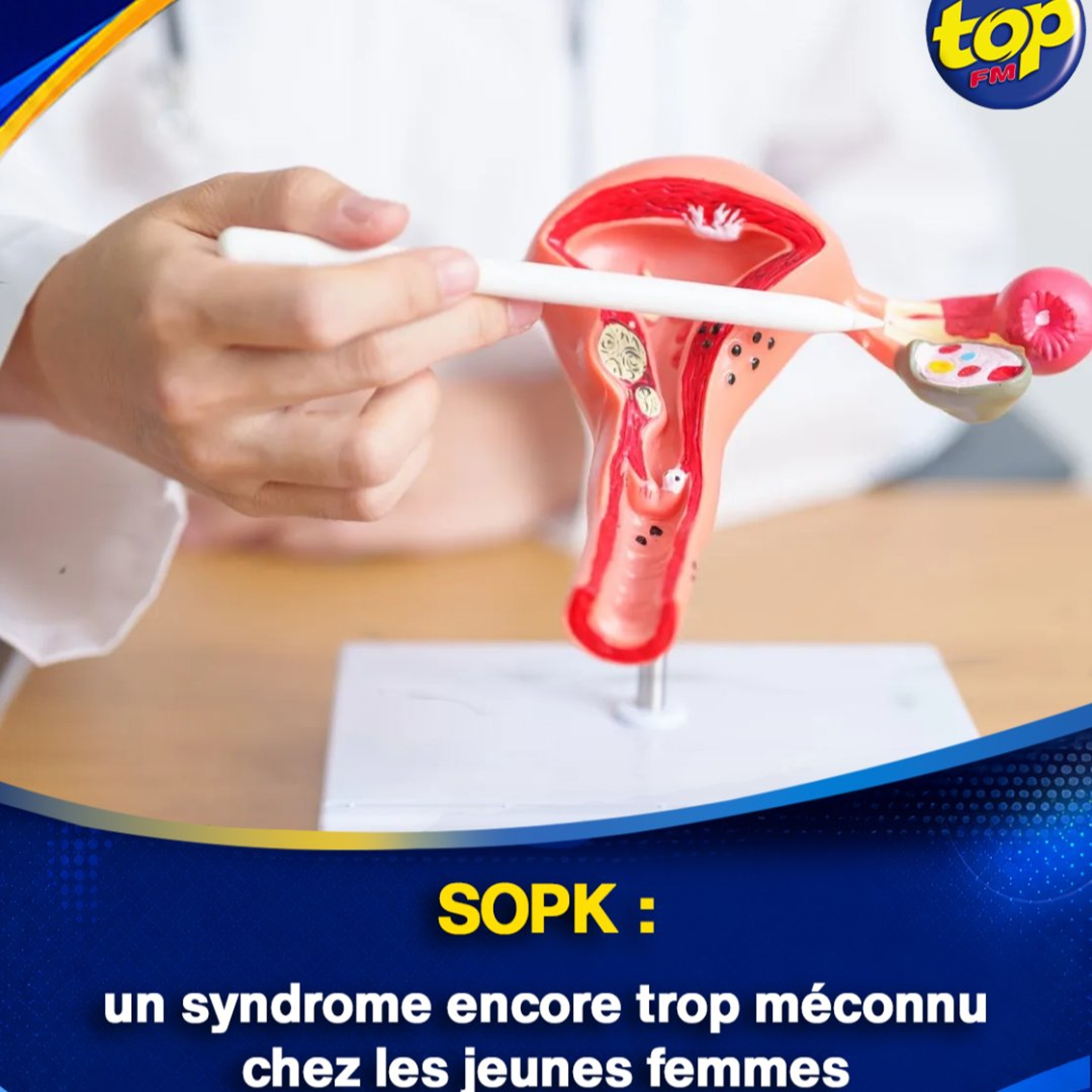 SOPK : un syndrome encore trop méconnu chez les jeunes femmes