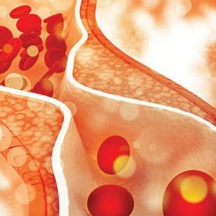 Atherosclerosis Help | Soften Artery Walls & Prevent Plaque and Blood Clots