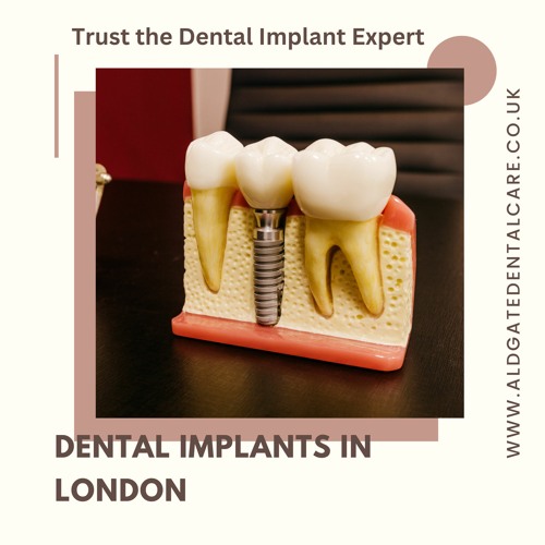 Stream episode Dental Implant in London 4 Benefits Of Implant Supported Dentures by Aldgate