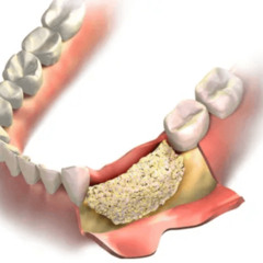 Healing and Recovery Journey of Bone Grafting in Washington