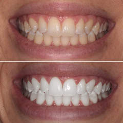 Teeth Whitening How to Achieve a Brighter Smile Safely