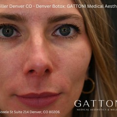 Lip Filler Denver CO - Denver Botox: GATTONI Medical Aesthetics