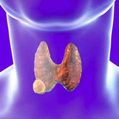 Thyroid Nodule Treatment | Shrink Thyroid Nodules & Regulate Thyroid Hormone Production