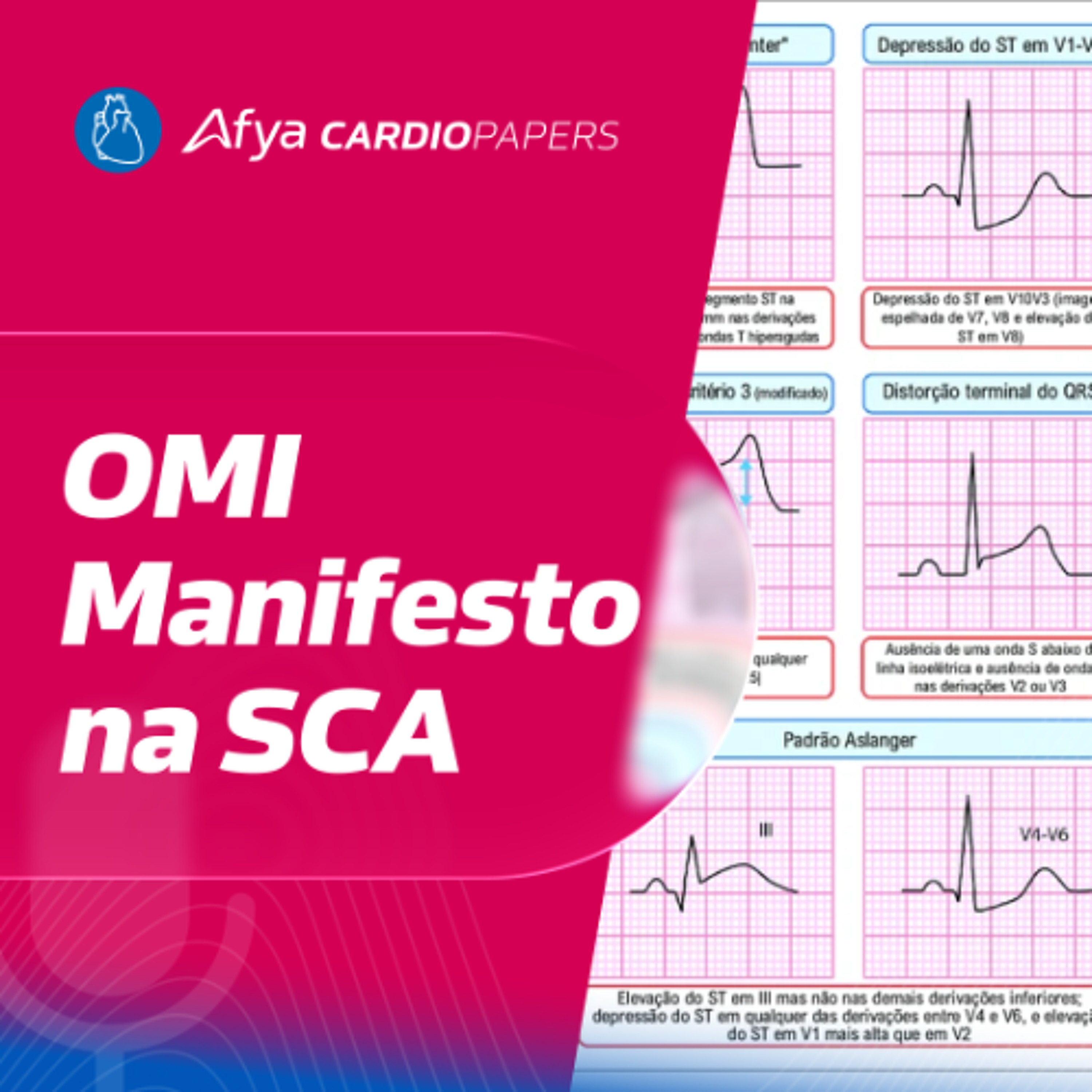 OMI Manifesto: o paradigma da oclusão coronariana aguda
