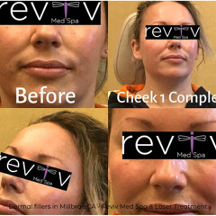Dermal fillers in Millbrae CA - Reviv Med Spa & Laser Treatment