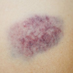 bruise