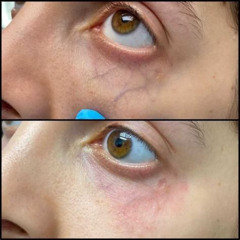 Best Under Eye Vein Treatment Reviews