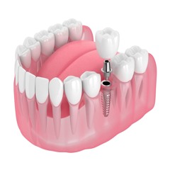 Revitalize Your Smile Exploring Dental Implants In Mitcham