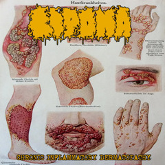 Lipoma - Chronic Inflammatory Dermatopathy (2024 Goregrind)