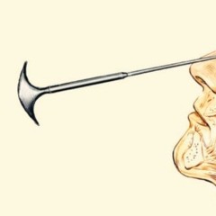 full frontal lobotomy