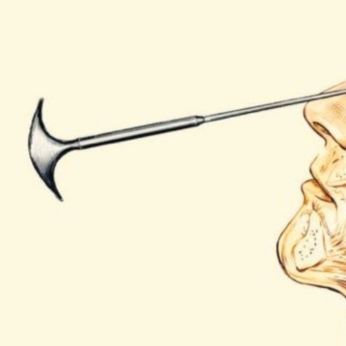 full frontal lobotomy
