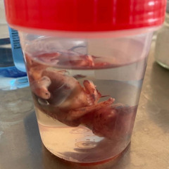 fetal expulsion