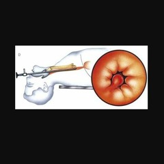 AÁrciga Podcast Esofagoscopía