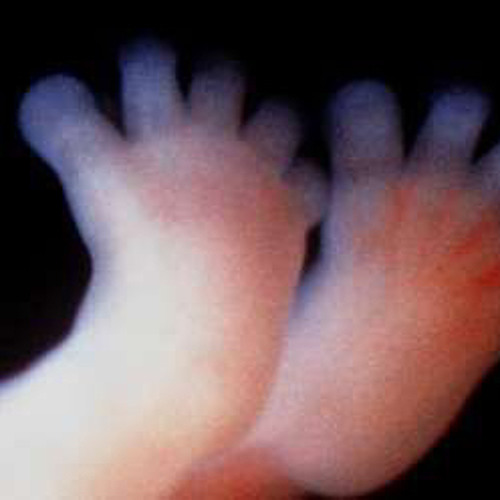 FETUS