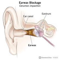 how it feels when you have an earwax blockage in your right ear and you have to listen to everything in mono and you can't mix or enjoy listening to music anymore because of it