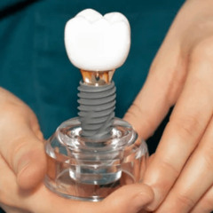 Complete Step-by-Step Journey to Dental Implants in Washington