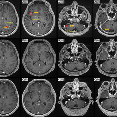 Rare Non-Small Cell Lung Cancer with Brain Metastases Responds to Amivantamab Monotherapy