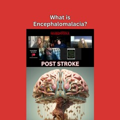 Post Stroke Damage: What is encephalomalacia?