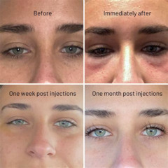 Best Prp Under Eye Treatment Near Me Reviews