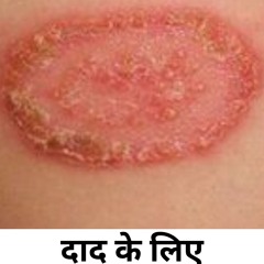 दाद के लिए प्राकृतिक घरेलू उपचार |Natural Home Remedies for Ringworm