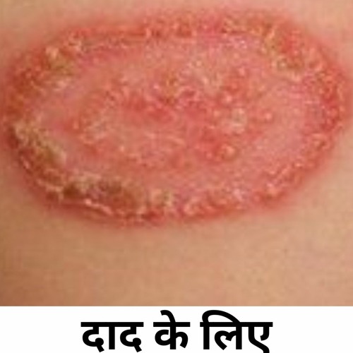 दाद के लिए प्राकृतिक घरेलू उपचार |Natural Home Remedies for Ringworm