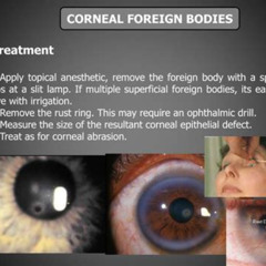 Best Foreign Body Eye Treatment Reviews