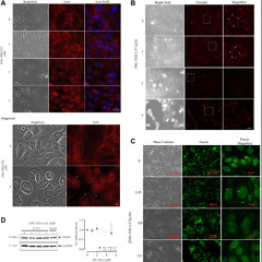 New Compound Disrupts Survival Pathways in Aromatase Inhibitor-Resistant Breast Cancer Cells