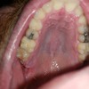 Taz's Tooth Problem! Does Spicoli's Sister, A Dental Hygienist Have A Solution?