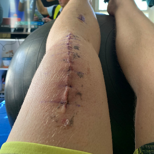 Coping strategies for mental health during times of injury