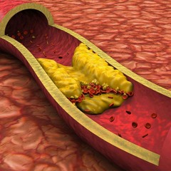 Blood Cholesterol Control [Update] | Lower Cholesterol Level & Prevent Cardiovascular Diseases