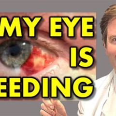 Best Broken Blood Vessel In Eye Natural Treatment Reviews
