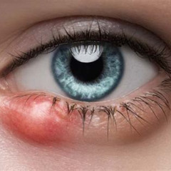 Best Treatments For Eye Stye Reviews