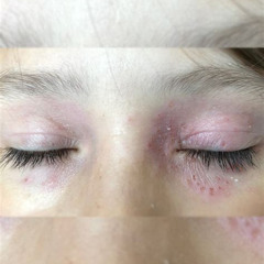 Best Rash Under One Eye Treatment Reviews