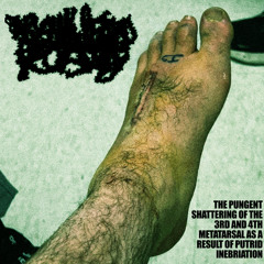 ABYSMAL WRETCHED FOOT SURGERY - THE PUNGENT SHATTERING OF THE 3RD AND 4TH METATARSAL AS A RESULT OF PUTRID INEBRIATION