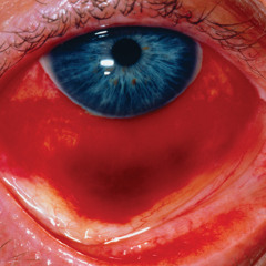 augen rot (sivex)