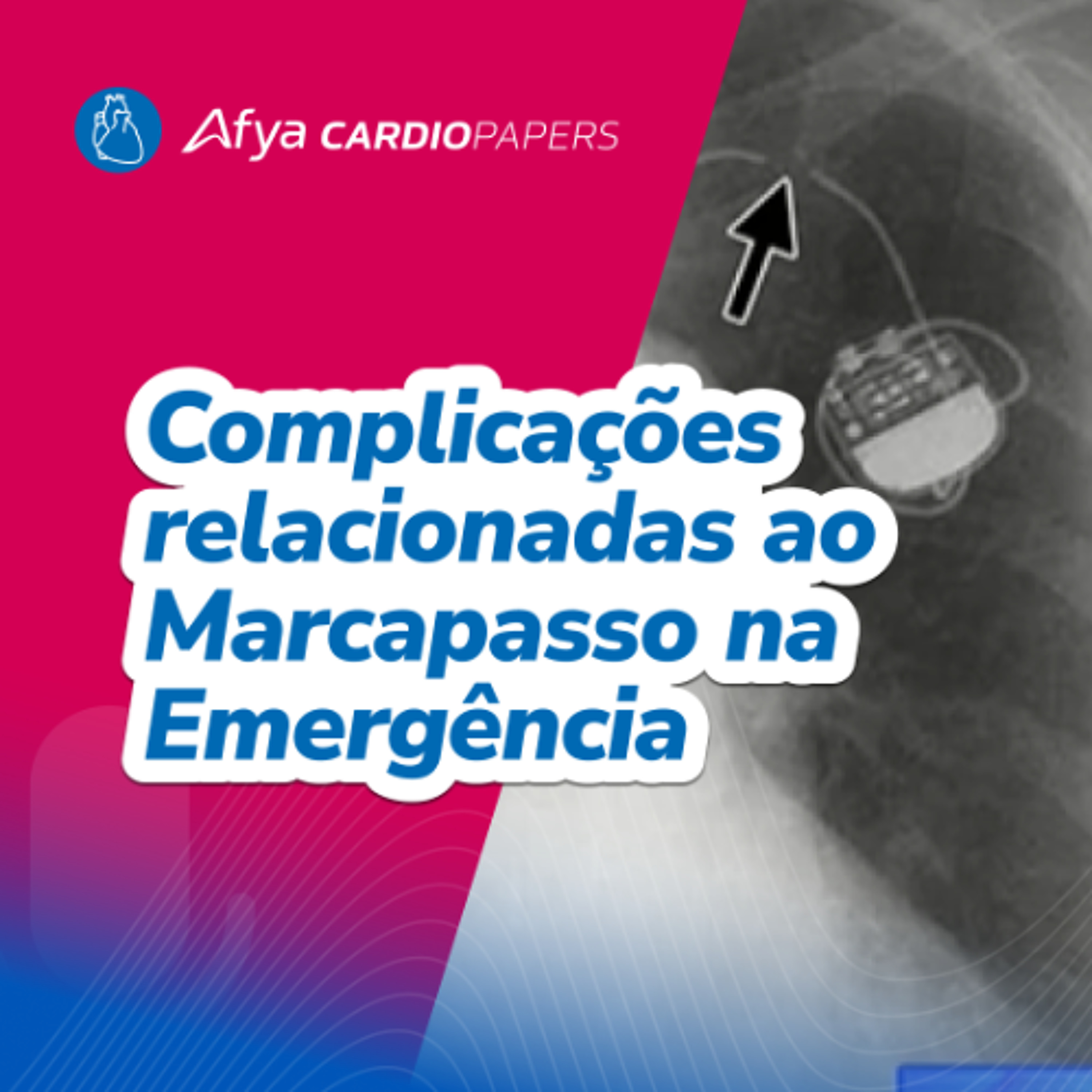 Complicações relacionadas ao Marcapasso na Emergência episode artwork