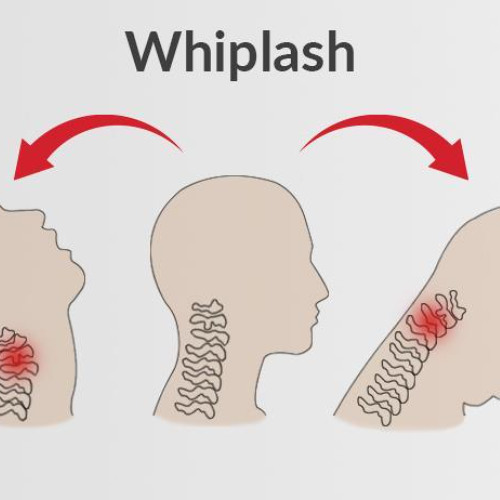 Whiplash
