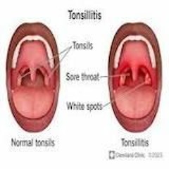 my tonsils (large)