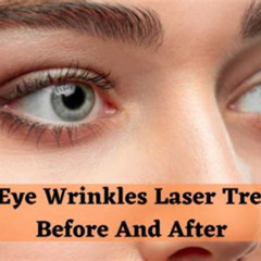 Best Laser Treatment Under Eye Wrinkles Reviews