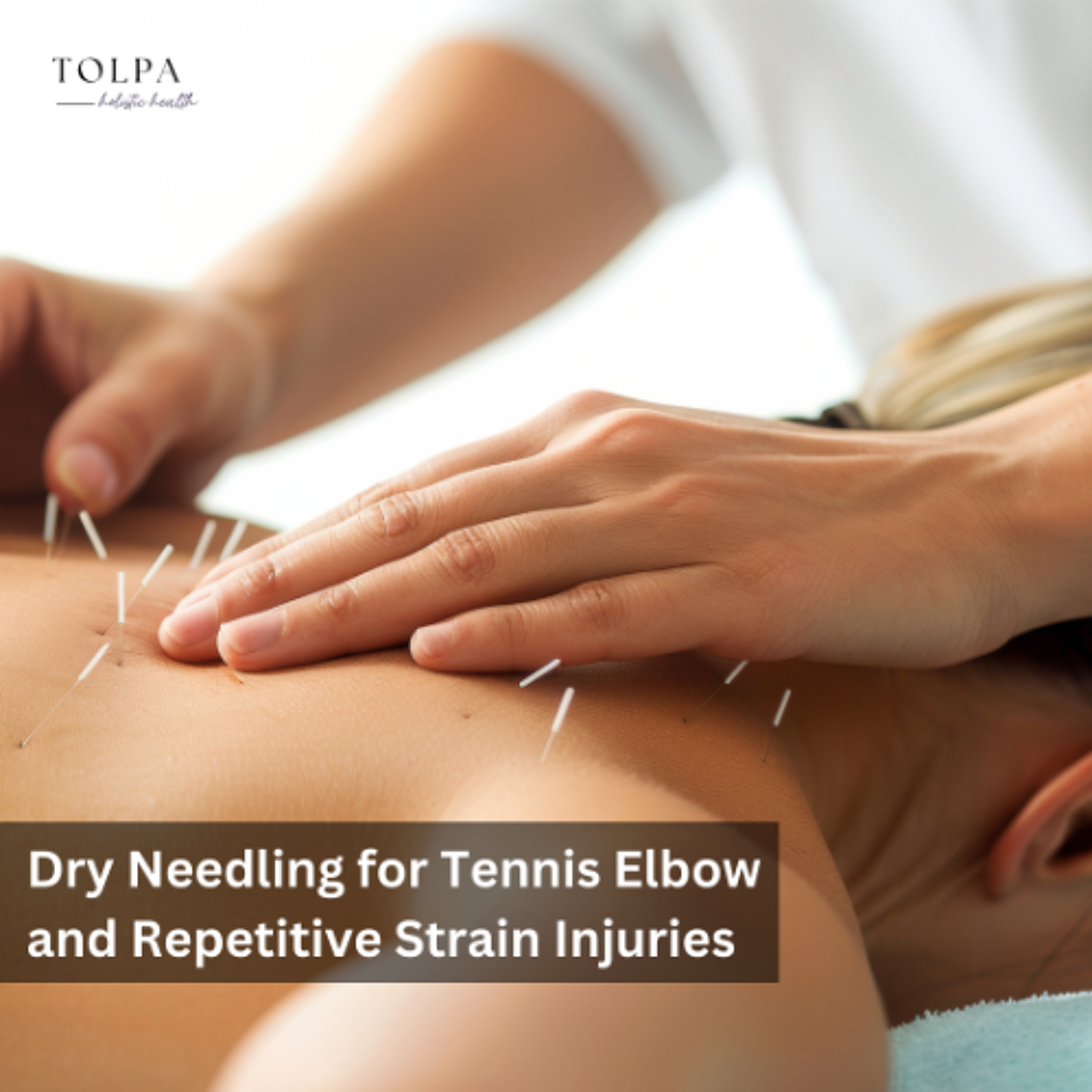 Dry Needling for Tennis Elbow and Repetitive Strain Injuries