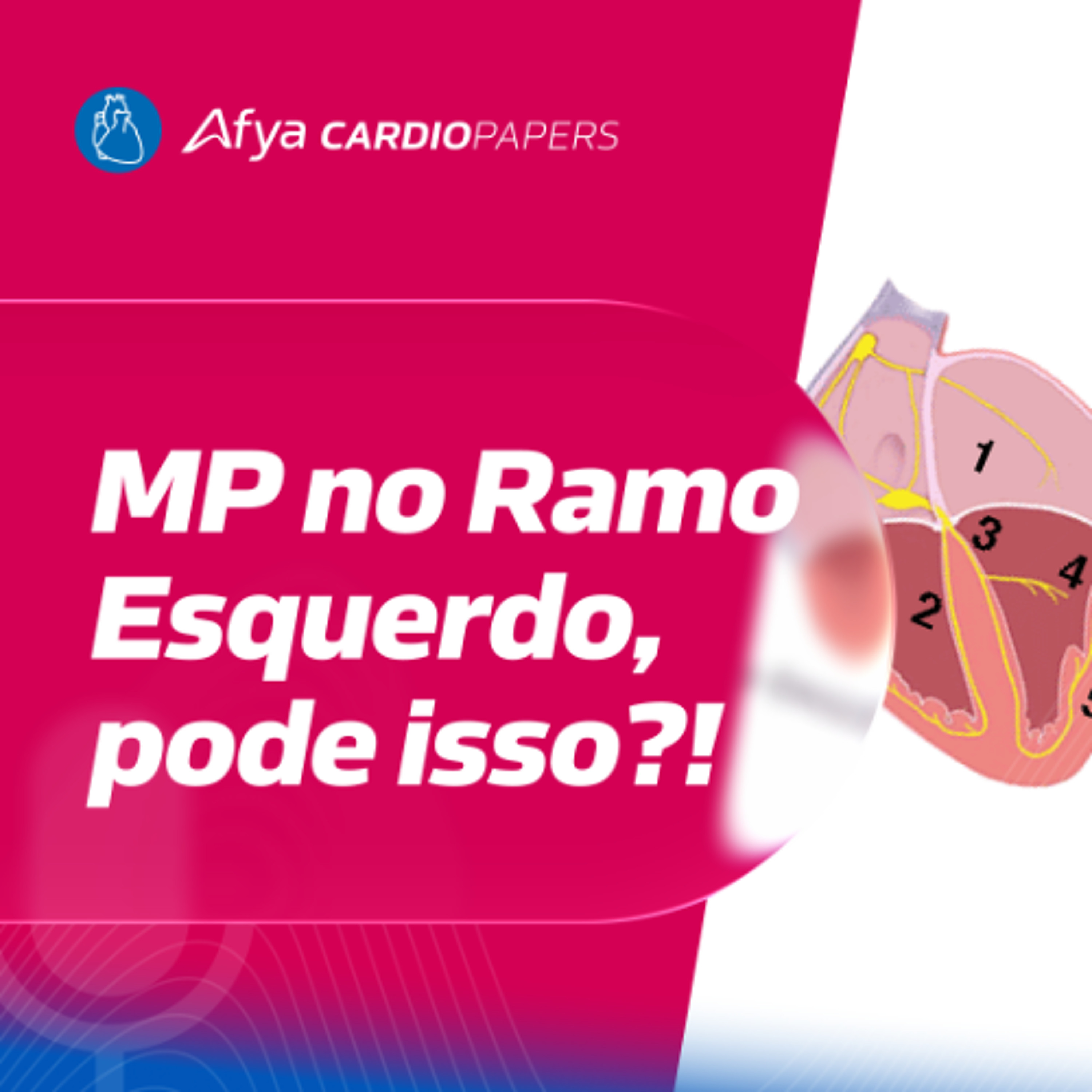 Marcapasso no Ramo Esquerdo - pode?