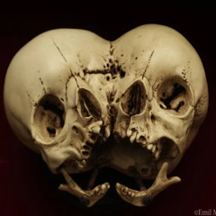 CONJOINED BY THE HEAD AT BIRTH (PRINCE MERCURY, RODRICK)