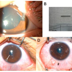 Best Foreign Body In The Eye Treatment Reviews