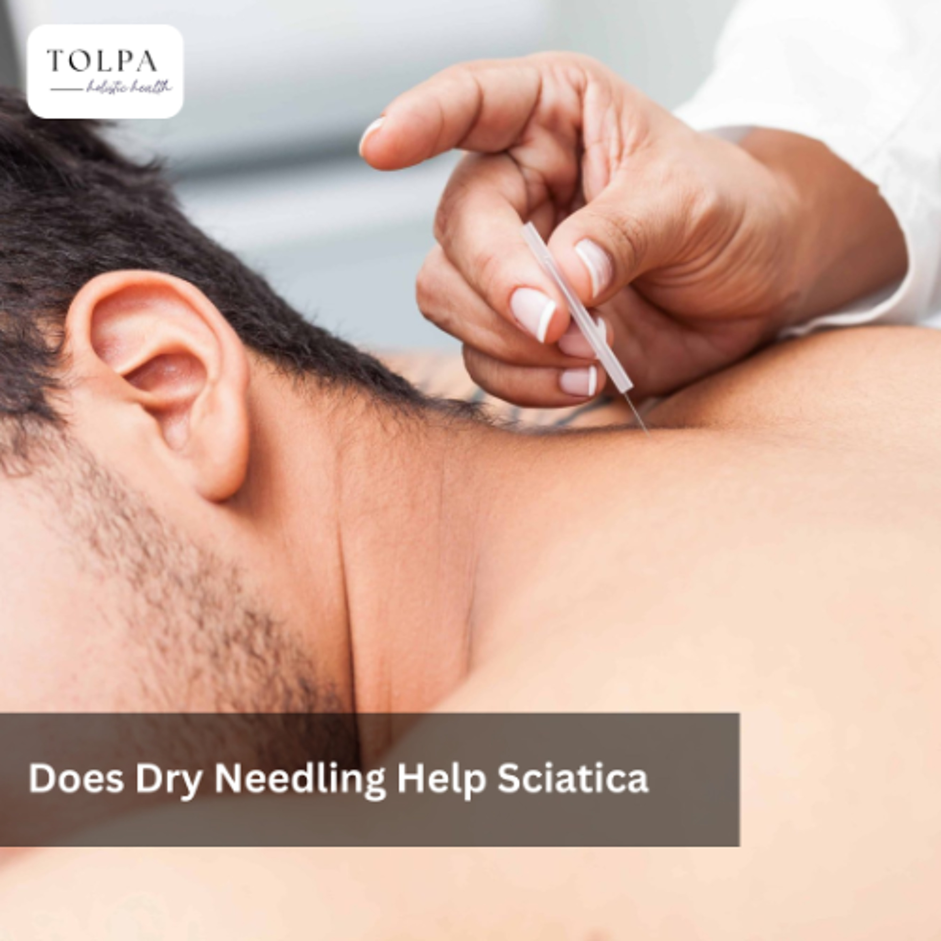 Does Dry Needling Help Sciatica? Relief, Benefits, and Treatment Options
