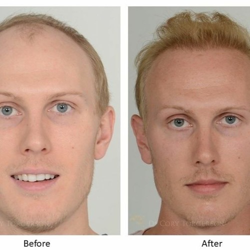 Stream “Zoom Dysmorphia” More men turning to cosmetic procedures and